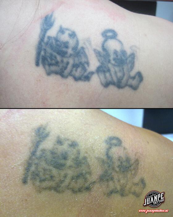 Laser para quitar Tatuajes