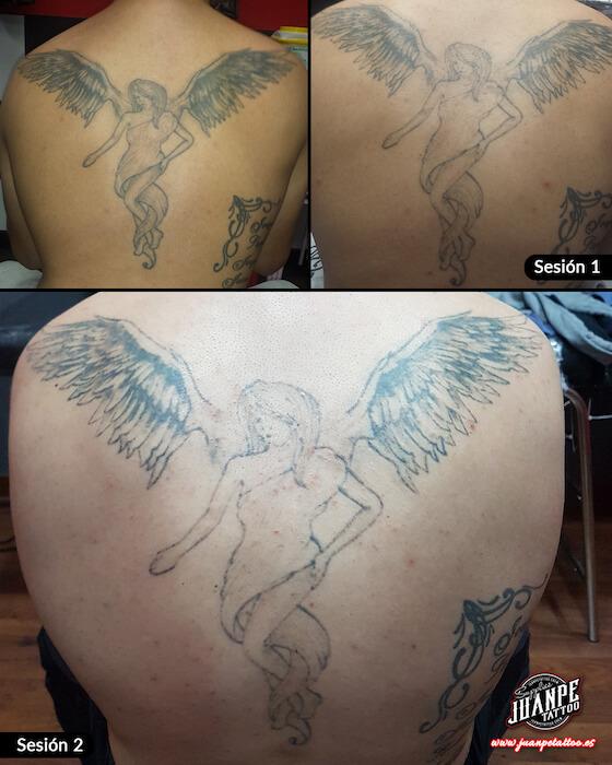 Laser para quitar Tatuajes