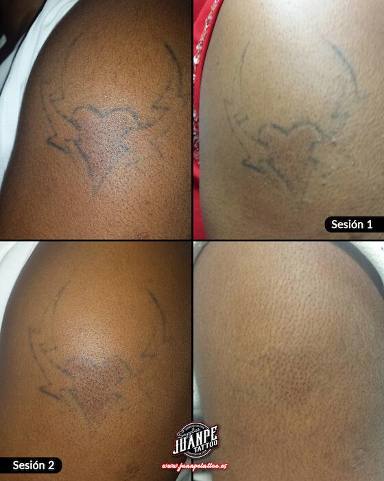 Laser para quitar Tatuajes