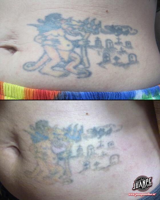 Laser para quitar Tatuajes