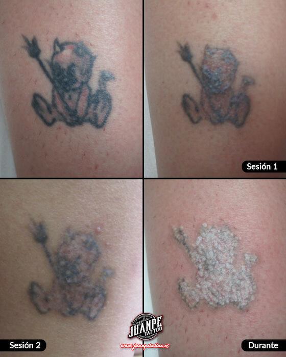 Laser para quitar Tatuajes