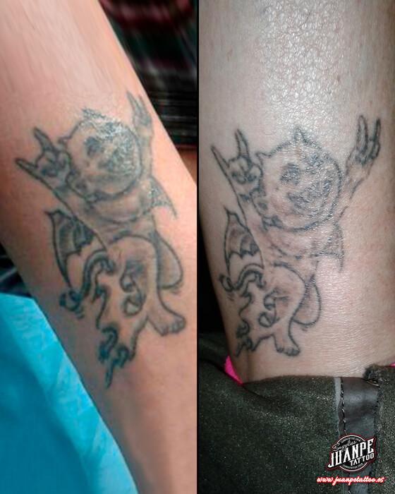 Laser para quitar Tatuajes