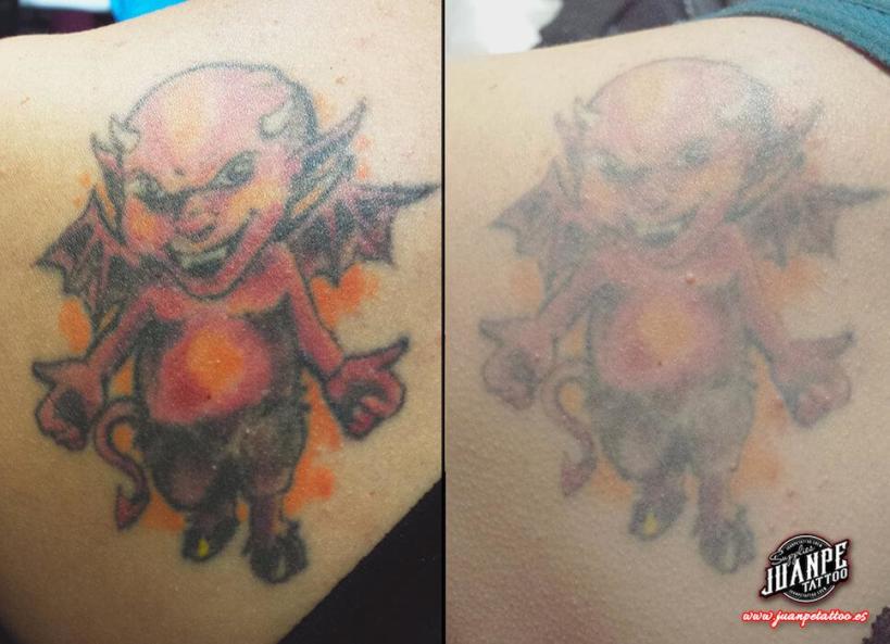 Laser para quitar Tatuajes