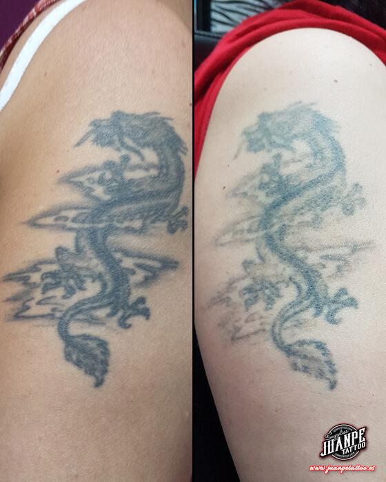 Laser para quitar Tatuajes