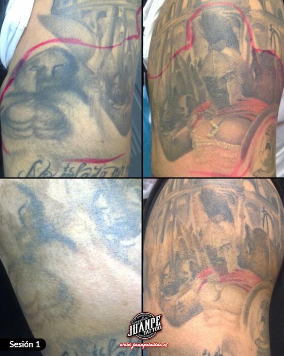 Laser para quitar Tatuajes