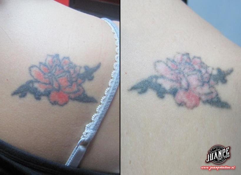 Laser para quitar Tatuajes