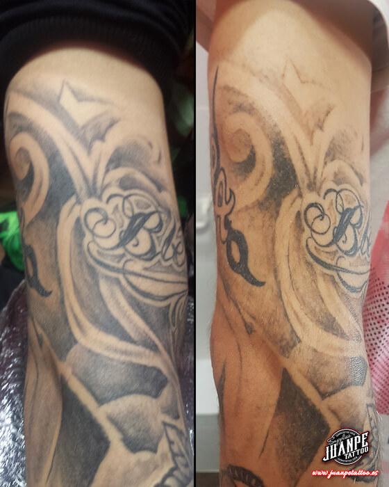 Laser para quitar Tatuajes