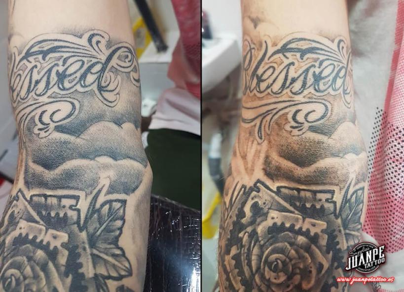 Laser para quitar Tatuajes