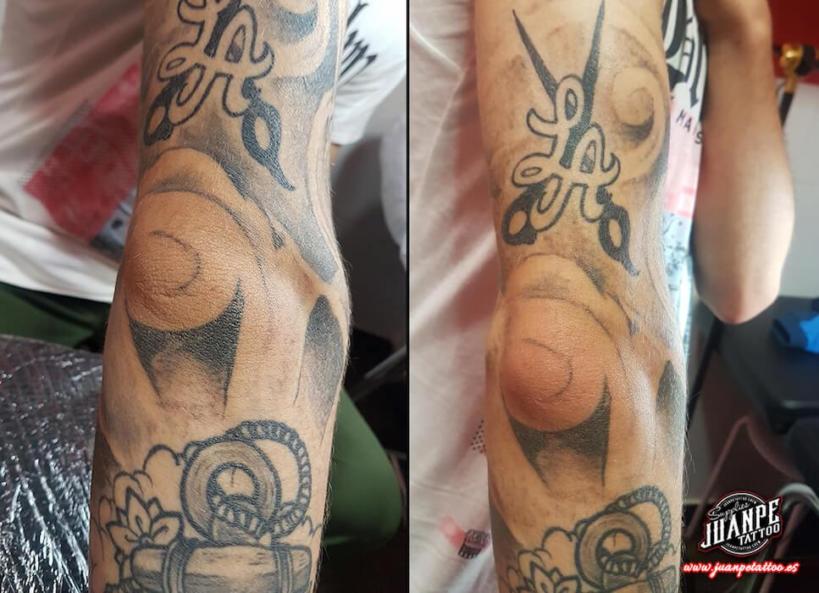 Laser para quitar Tatuajes