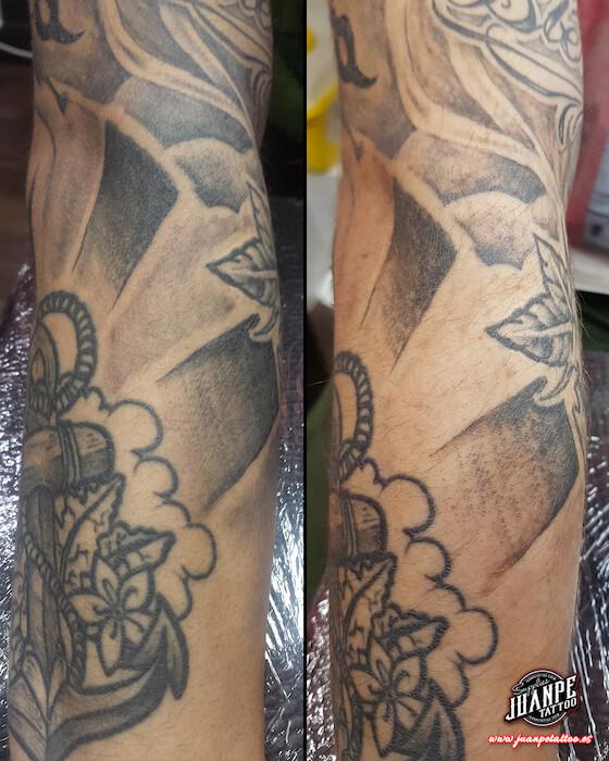 Laser para quitar Tatuajes