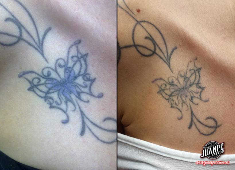 Laser para quitar Tatuajes