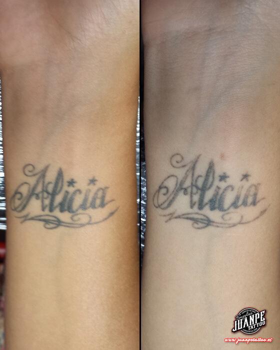 Laser para quitar Tatuajes