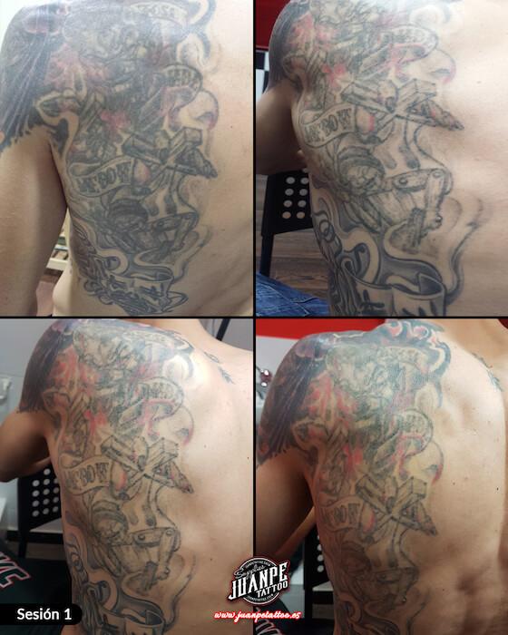 Laser para quitar Tatuajes