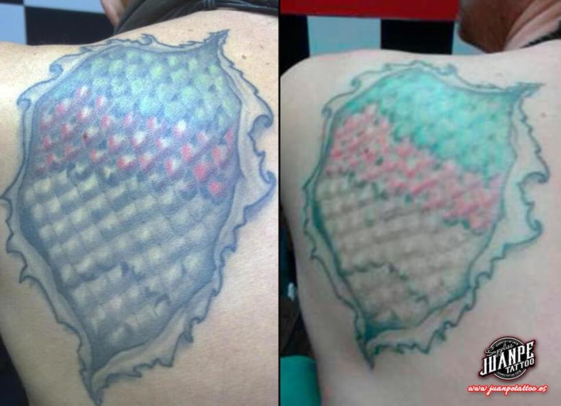 Laser para quitar Tatuajes
