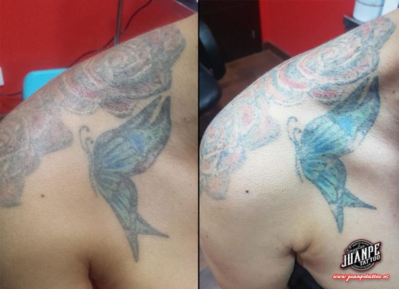 Laser para quitar Tatuajes