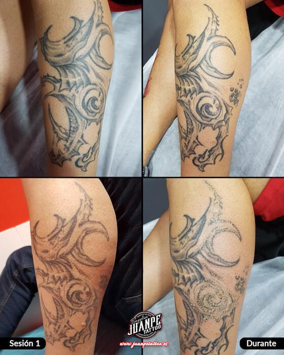 Laser para quitar Tatuajes