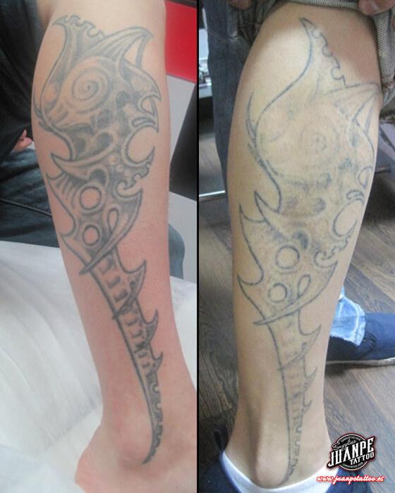 Laser para quitar Tatuajes